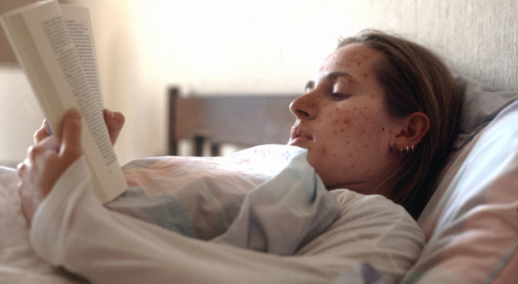 Morbillo, allarme mondiale: torna negli USA e dilaga in Europa. In Italia casi raddoppiati in un mese